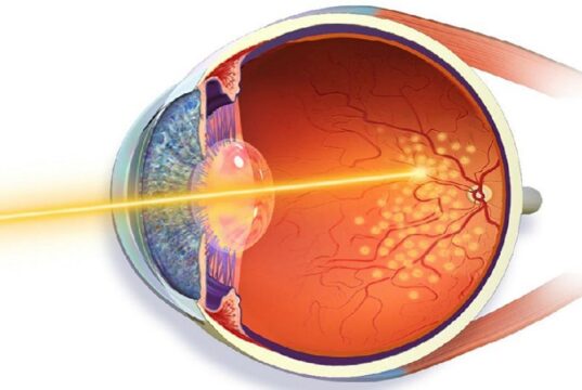 Что представляет собой лазерная коагуляция сетчатки глаза?