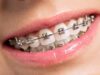 В каком возрасте лучше ставить брекет-системы?