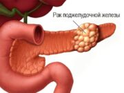 Первые сигналы тревоги: симптомы раковой кахексии