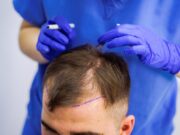 Современные методы трансплантации волос