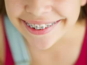 Какие брекеты устанавливать ребенку?