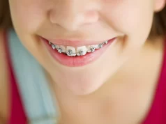 Какие брекеты устанавливать ребенку?