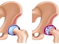 Остеоартроз тазобедренного сустава