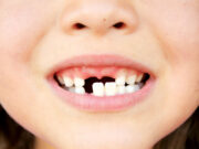 Особенности удаления молочных зубов у детей