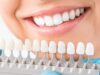 Как правильно выбрать виниры для зубов?