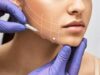 Нитевое армирование: действенный метод по малотравматичной подтяжке кожных покровов лица и тела