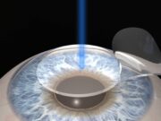 Лазерная коррекция зрения Фемто-ЛАСИК