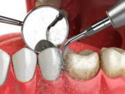 Как удаляют зубной камень в стоматологии?