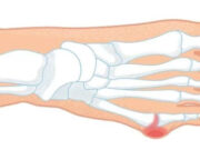 Деформация Тейлора: причины, симптомы и эффективные методы лечения патологии пятого пальца стопы