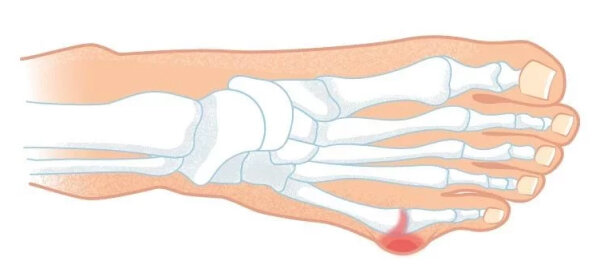 Деформация 5 пальца. Деформация 5 плюсневой кости. Косточка халюс вальгус. Деформация тейлора 5 плюсневой кости. Деформация тейлора 5 плюсневой кости.