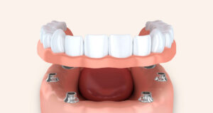 Виды протезирования при полном отсутствии зубов