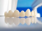 Этапы установки диоксид-циркониевых коронок: особенности подготовки и преимущества протезирования