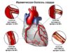 С чего начать лечение ишемической болезни сердца?