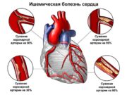 С чего начать лечение ишемической болезни сердца?