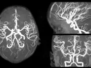 Виды МРТ головного мозга с сосудами