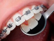 Основные этапы ортодонтического лечения