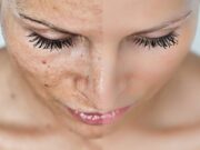 Как избавиться от пигментных пятен на лице и теле?