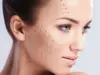 Нитевой лифтинг лица: идеально подходит для профилактики и коррекции небольших возрастных изменений