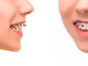 Этапы установки брекетов