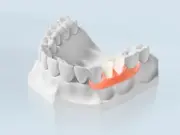 Иммедиат протез: быстро и эффективно восстановим улыбку