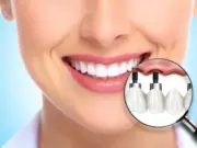 Тотальное протезирование зубов: новая жизнь для вашей улыбки