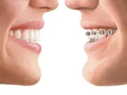 Исправление прикуса зубов: путь к здоровой улыбке