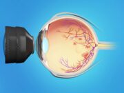 Лазерная коагуляция сетчатки глаза: что это и зачем она нужна?