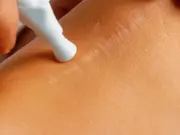 Как избавиться от шрамов после эндопротезирования: Полное руководство для каждого