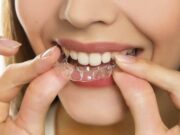 Исправление прикуса без брекетов: мифы и реальность