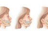 Виды прикуса: особенности, лечение