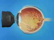 Лазерная коагуляция сетчатки глаза: что это и почему это важно?