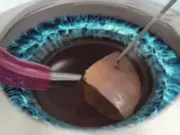 Современные методы хирургического лечения катаракты: ультразвуковая факоэмульсификация и имплантация ИОЛ