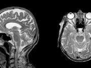 МРТ головного мозга: когда нужно делать и что показывает?