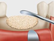 Костная пластика в стоматологии: цена и что нужно знать перед процедурой