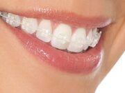 Эстетическая ортодонтия: как сделать улыбку по-настоящему красивой