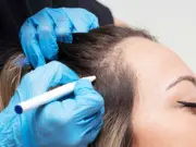 Пересадка волос женщинам: что важно знать перед решением