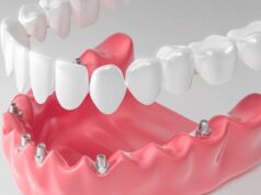 Как вернуть улыбку: всё про протезирование зубов