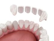 Уход за винирами: что можно и чего лучше избегать