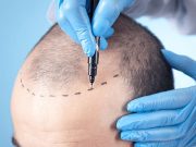 Пересадка волос: как не растеряться и выбрать то, что действительно работает