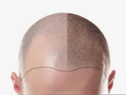 Микропигментация волос MSMP в Москве: как вернуть вид густой шевелюры без операций