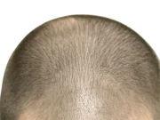 Как вернуть густоту: пересадка волос для мужчин ручным методом FUE Hand без лишней шумихи