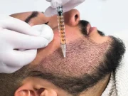 Новая борода без магии: что нужно знать о пересадке волос на бороду