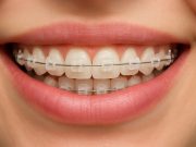 Керамические брекеты: эстетика и эффективность в исправлении прикуса